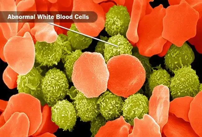 Leukemia is cancer of the blood cells.