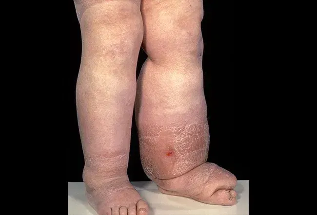 Picture of Lymphedema