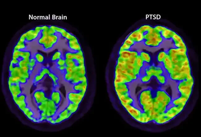 PTSD causes an overactive amygdala. 