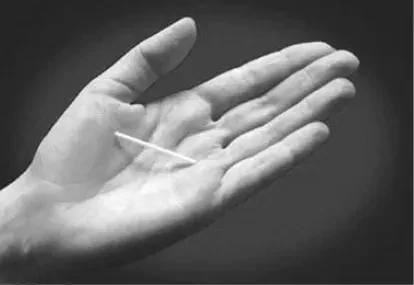 IMPLANON® (etonogestrel implant)Figure Illustration