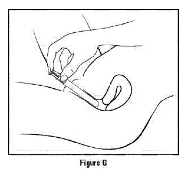 Insert the applicator - Illustration