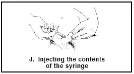 Remove the needle cover - Illustration